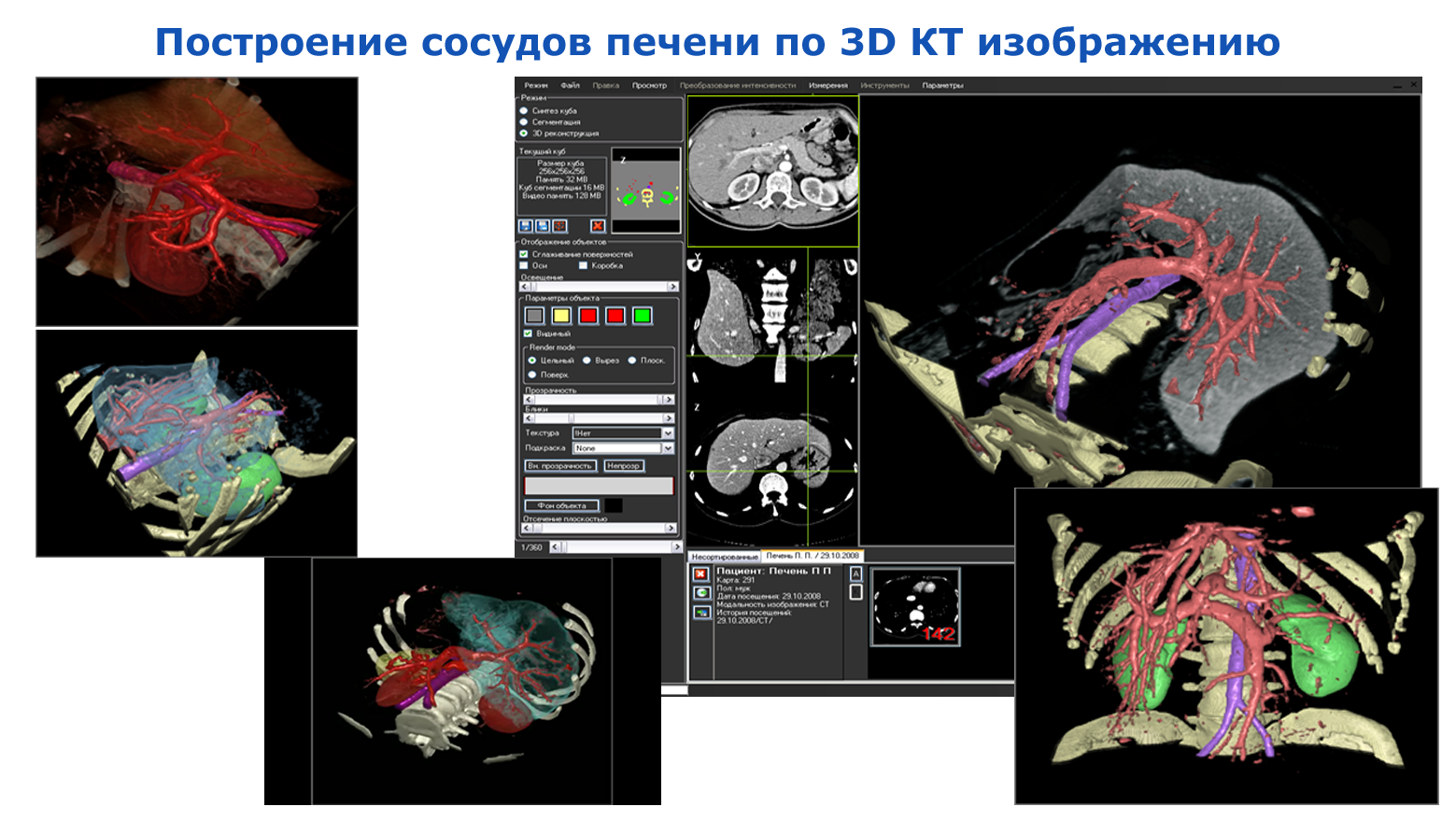 Построение сосудов печени по 3D КТ изображению