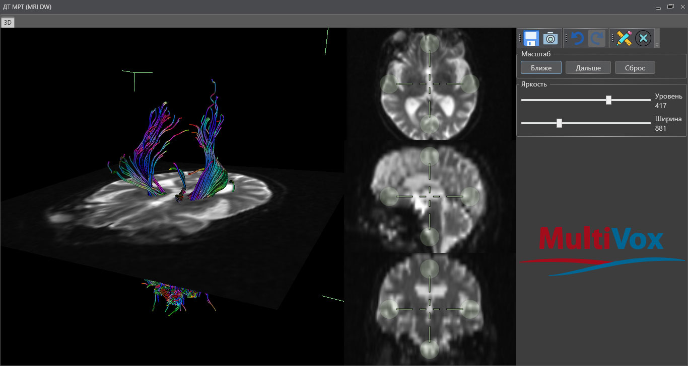 Совмещение с данными диффузионно-взвешенной (МР) трактографии